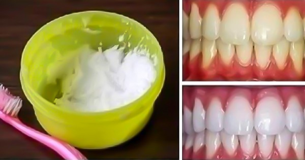 Как отбелить зубы в домашних условиях за 3 минуты: 100%-й результат!