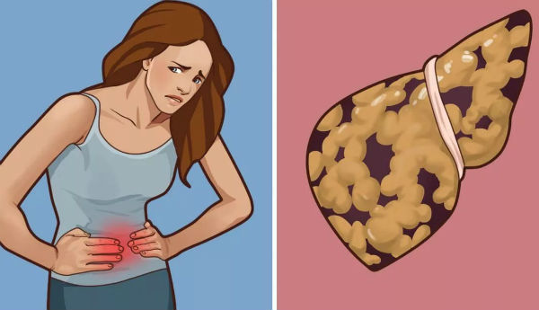 Хотите узнать, есть ли у вас жировая болезнь печени? Вот ее основные симптомы