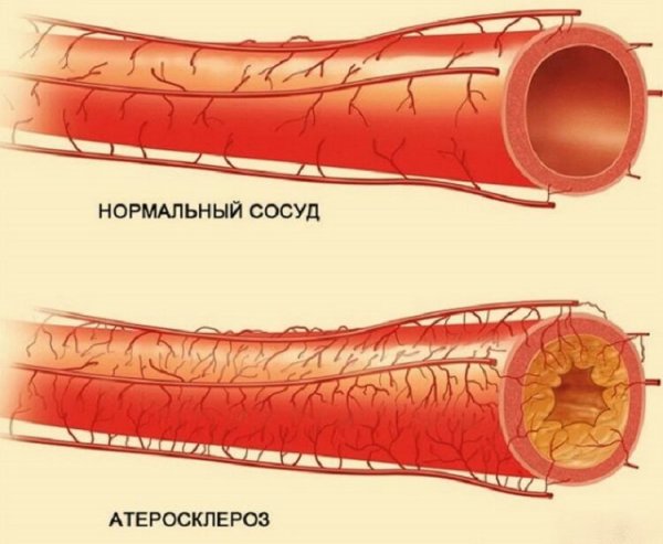 Самое эффективное очищение артерий благодаря всего 50 мл этого средства в день