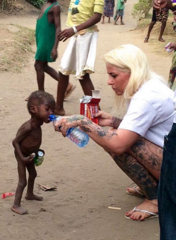 Как стал выглядеть спасенный мальчик, едва не умерший от недоедания