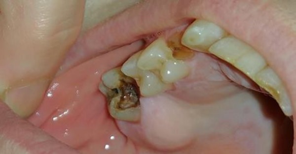Благодаря этому известному лекарственному средству поврежденные зубы смогут восстанавливаться. Сенсационно!