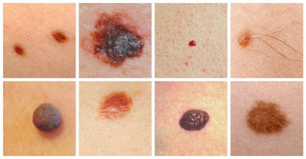 Учимся определять и предотвращать рак кожи