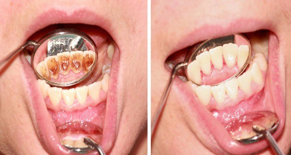 Как избавиться от зубного налета и заболевания десен без дорогостоящих методов лечения