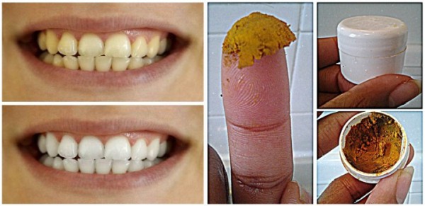 Эта паста, которую легко сделать самостоятельно, безопасно отбелит ваши зубы и вылечит дёсна