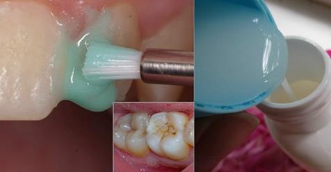 Эффективное отбеливание зубов в домашних условиях: лучше профессиональной чистки!