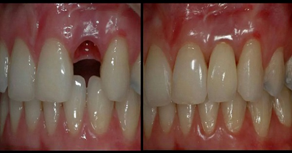 Вырастить новые зубы за 9 недель: процедура, которая возможна в любом возрасте!