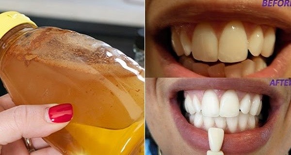 Полощите ротовую полость одним простым ингредиентом и смотрите, что произойдет с вашими зубами